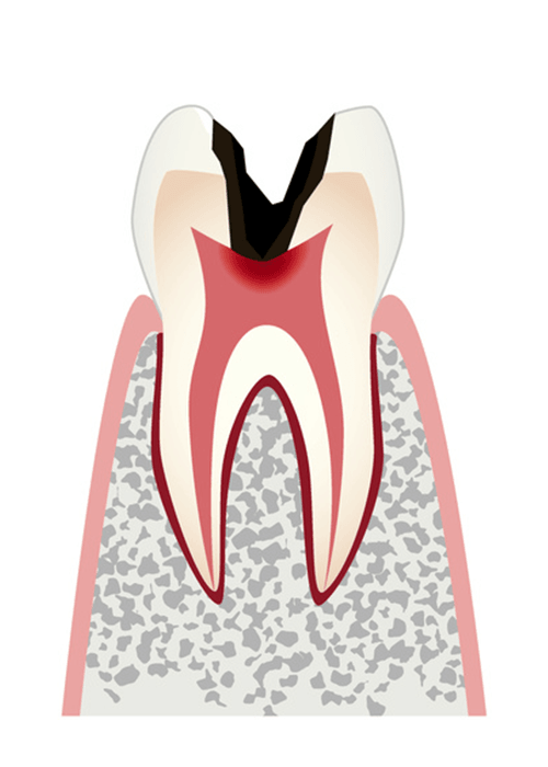 C3歯髄(神経)まで進行したむし歯